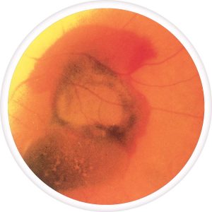 advanced-hemorrhagic-macular-degeneration-300x300
