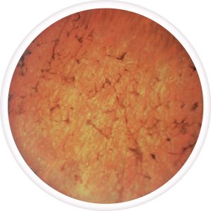 advanced-retinitis-pigmentosa-300x300