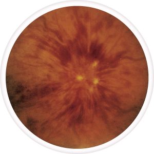 central-retinal-vein-occlusion-300x300