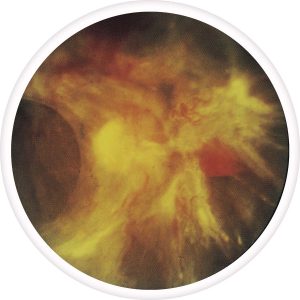 end-stage-diabetic-retinopathy-300x300