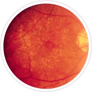 macular-drusen-300x300