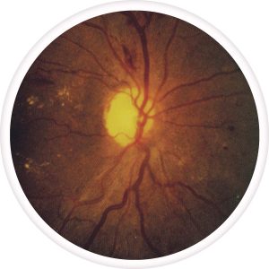 nonproliferative-diabetic-retinopathy-300x300