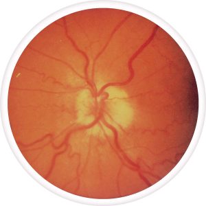 optic-neuritis-300x300