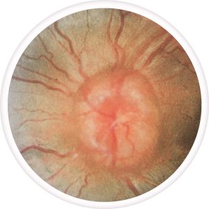 papilledema-300x300