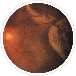 retinal-detachment-300x300