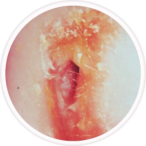 acute-otitis-externa-300x300