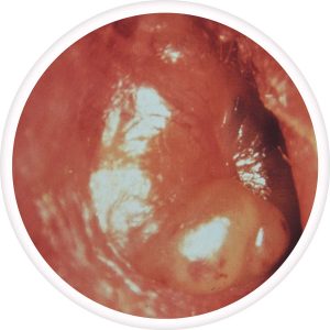 acute-otitis-media-300x300