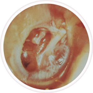 adhesive-otitis-media-300x300