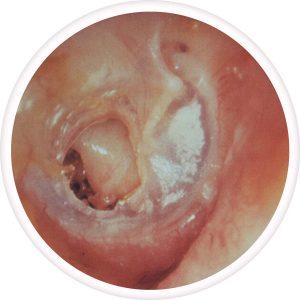 central-perforation-of-th-tympanic-membrane-300x300
