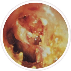 cholsteatoma-300x300