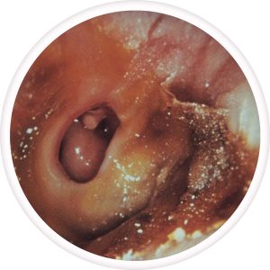 chronic-suppurative-otitis-media-300x300
