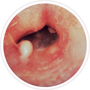 exostosis-300x300