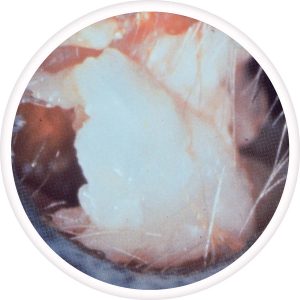 keratosis-obturans-300x300