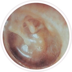 normal-tympanic-membrane-300x300