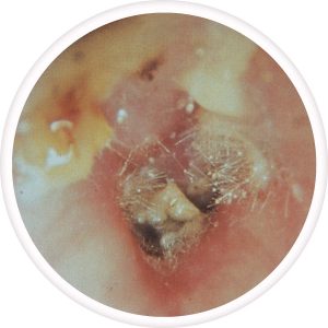 otomycosis-300x300