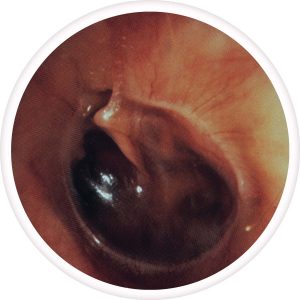 serous-otitis-media-300x300