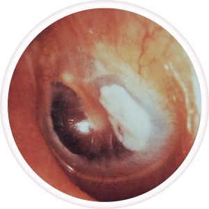 tympanosclerosis-300x300