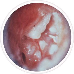 tympanosclerosis-ossicles-300x300