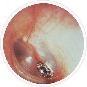 tympanostomy-tube-300x300