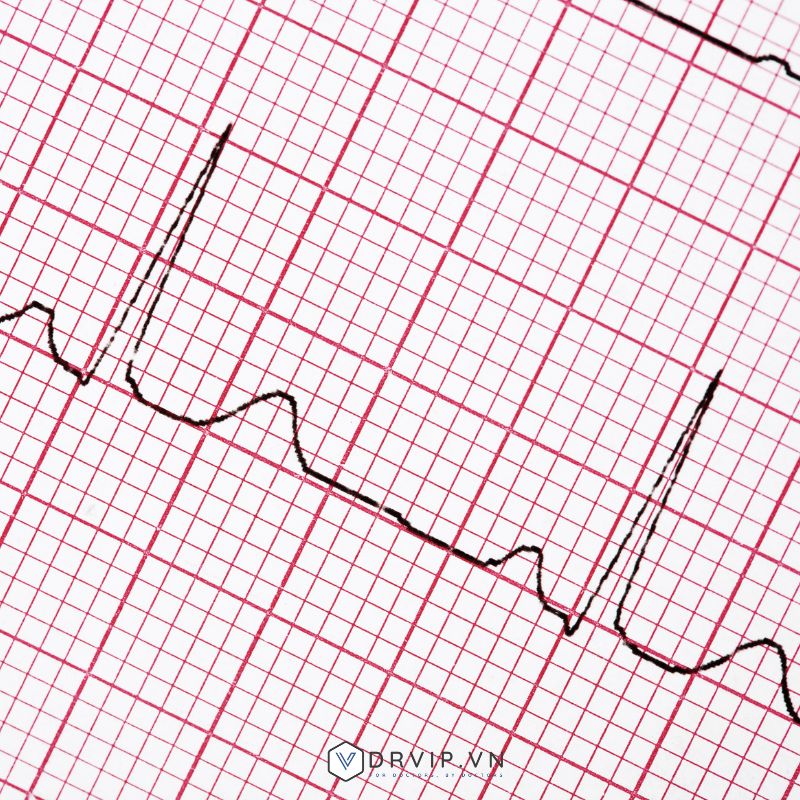 Chỉ số ECG bình thường