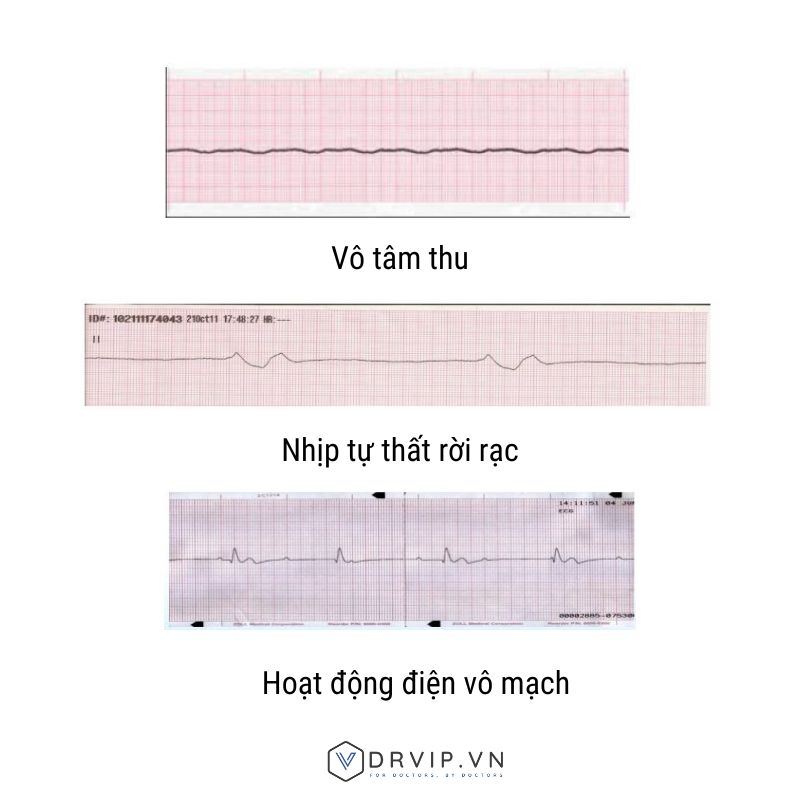 Chống chỉ định Sốc điện phá rung