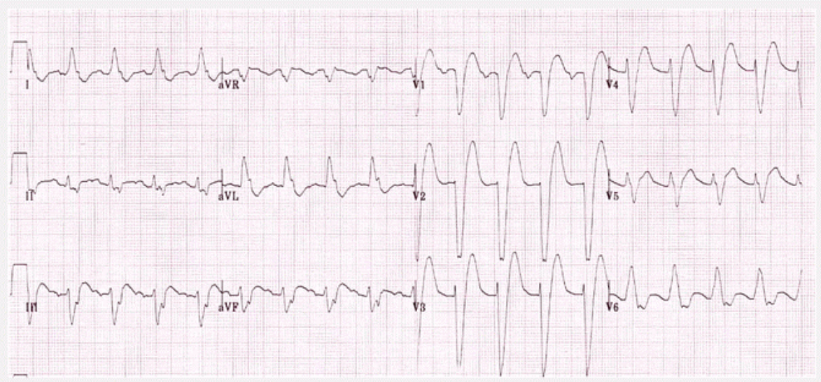 QRS
