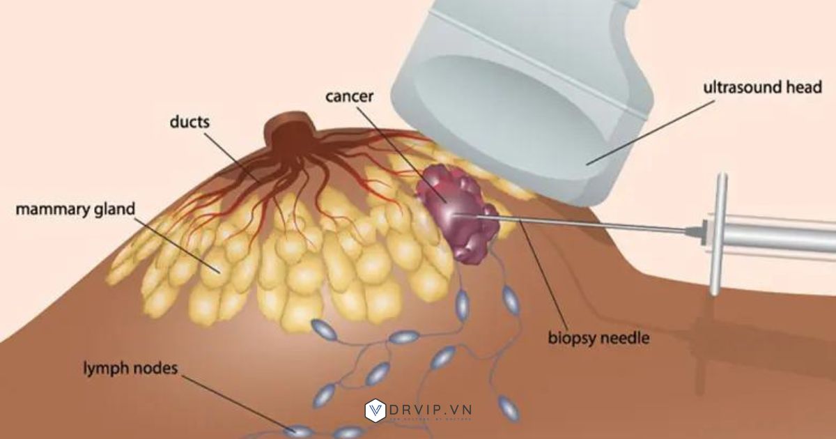 Sinh thiết lõi kim ở vú