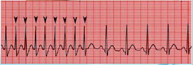 phức bộ QRS