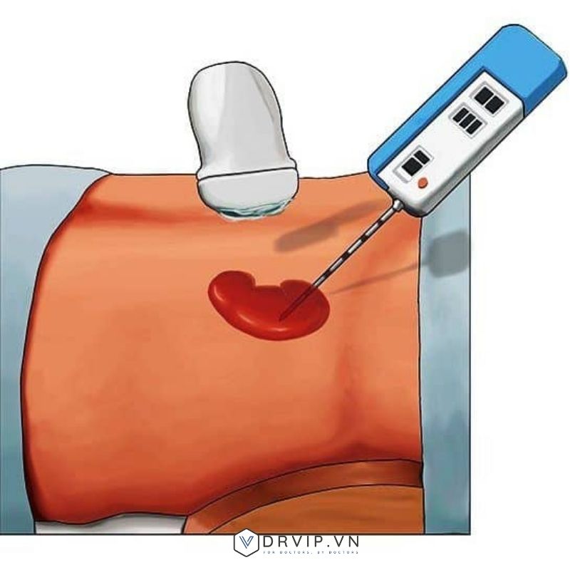 Sinh thiết thận dưới hướng dẫn siêu âm