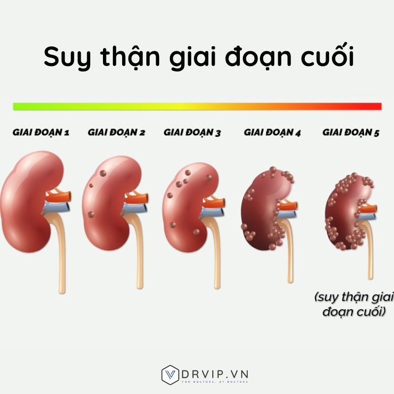 Suy-than-giai-doan-cuoi