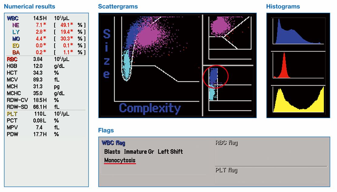 Monocytosis
