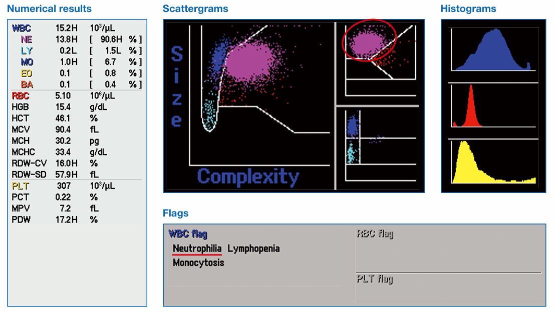 Neutrophilia